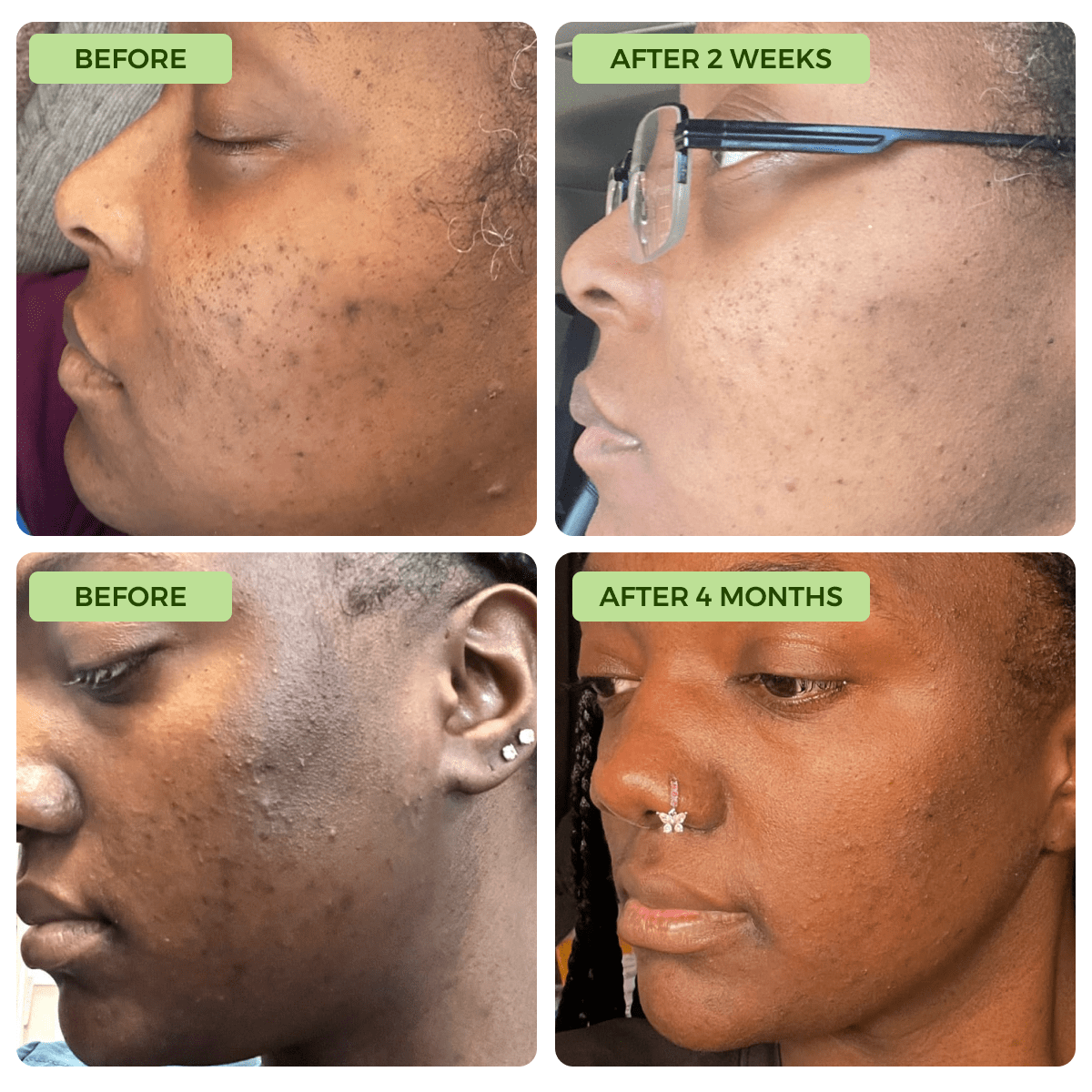 Clearance Blowout! 🚨 Anti-Acne & Dark Spots African Soap