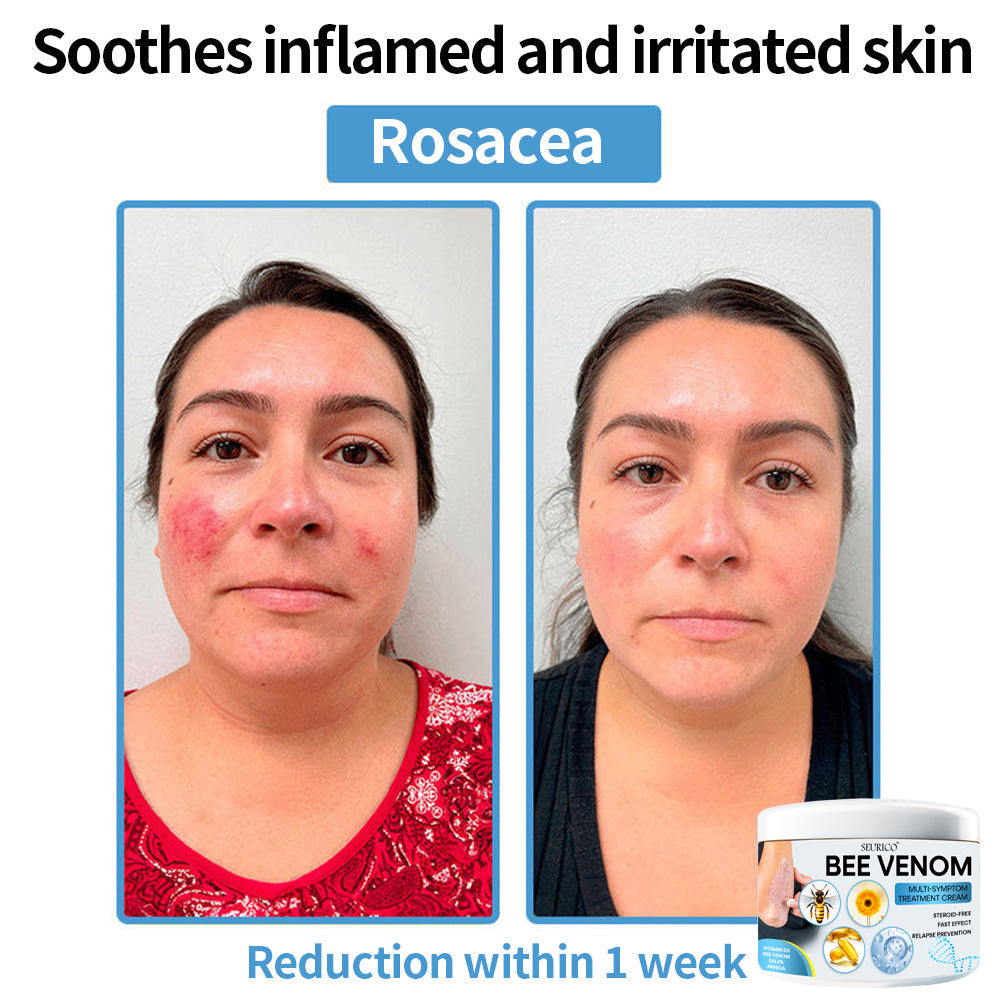 ✨2025 New Arrival🎁Seurico™ Bee Venom Multi-Symptom Treatment Cream⚡Limited Time Only: Get 50% Off Now! 🔥