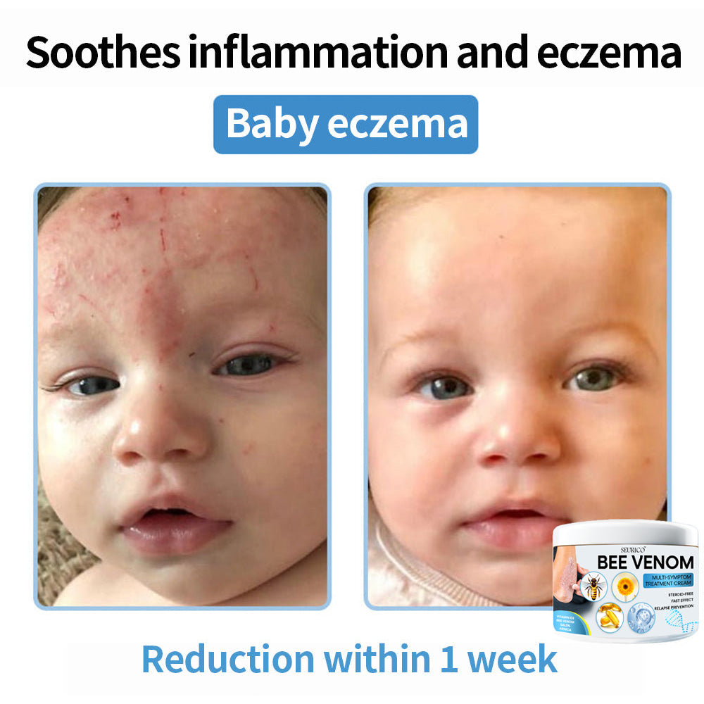 ✨2025 New Arrival🎁Seurico™ Bee Venom Multi-Symptom Treatment Cream⚡Limited Time Only: Get 50% Off Now! 🔥