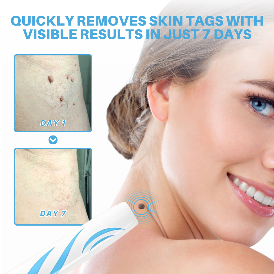 Odeiun™ Painless At-home Skin Tag Removal Pen