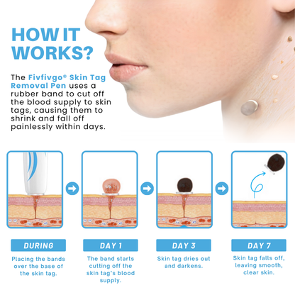 Odeiun™ Painless At-home Skin Tag Removal Pen