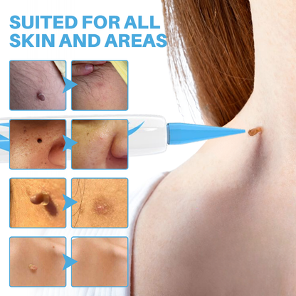 Odeiun™ Painless At-home Skin Tag Removal Pen