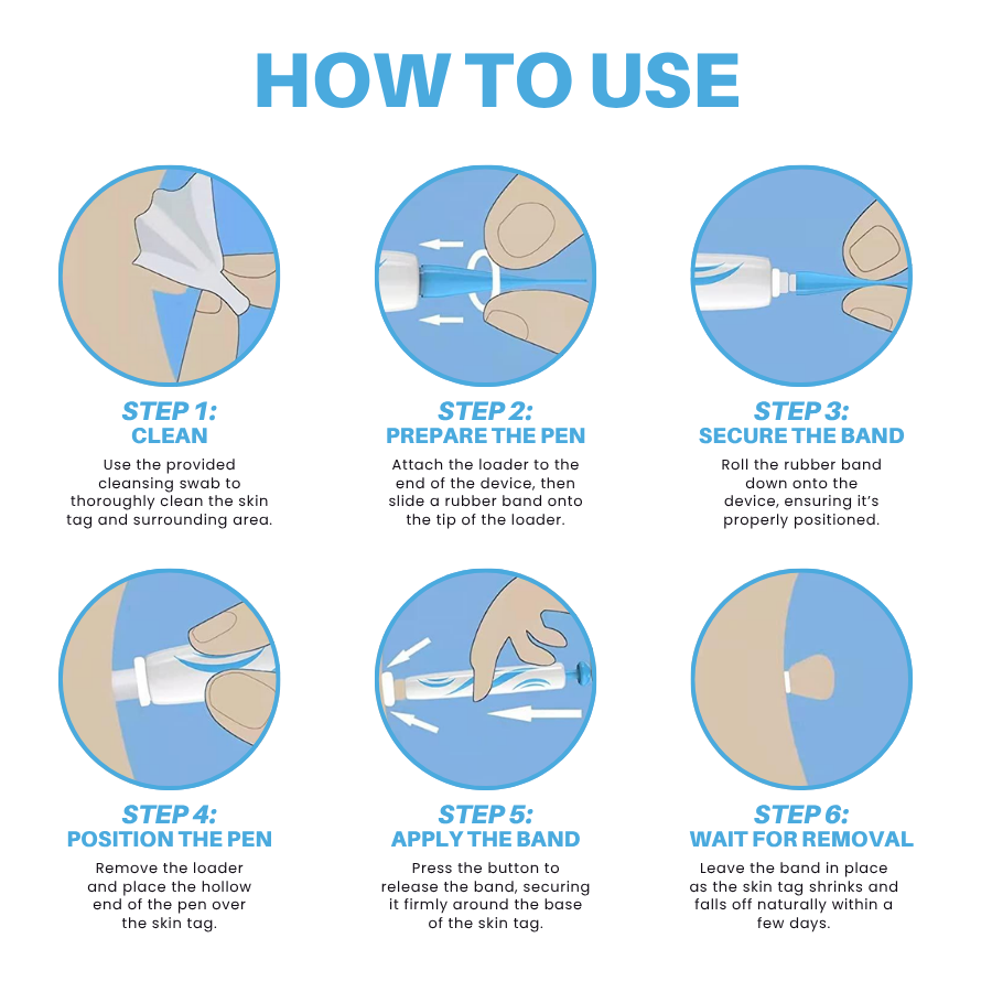Odeiun™ Painless At-home Skin Tag Removal Pen