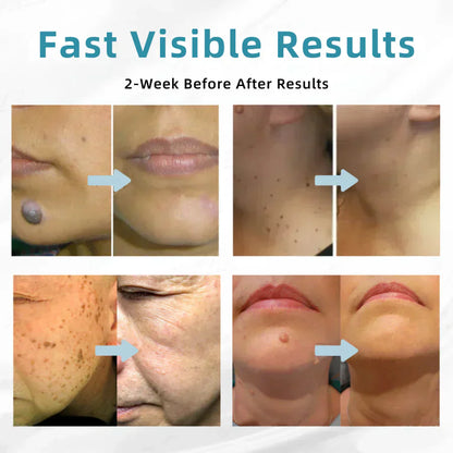 🔥Seurico™ VelvetSkin+ All-in-One Laser Eraser Pen✨ | Safe & Easy At-Home Solution for Smooth, Spot-Free Skin 💆‍♀️🌟