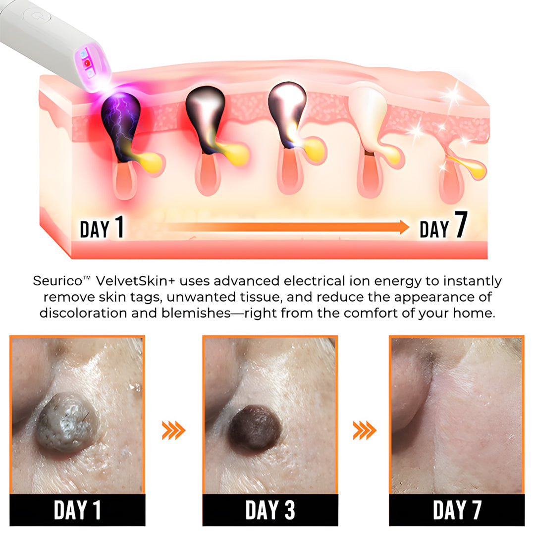 🔥Seurico™ VelvetSkin+ All-in-One Laser Eraser Pen✨ | Safe & Easy At-Home Solution for Smooth, Spot-Free Skin 💆‍♀️🌟
