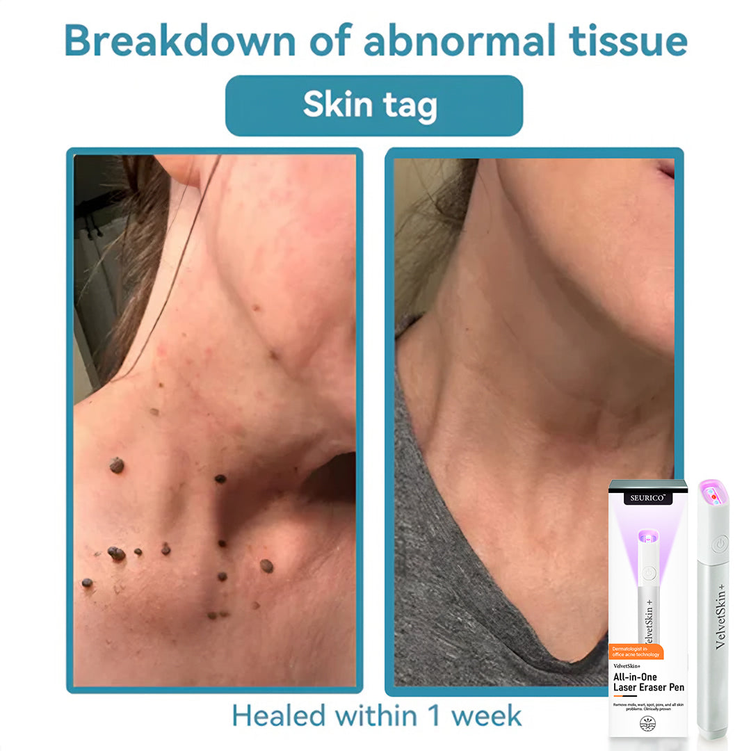 🔥Seurico™ VelvetSkin+ All-in-One Laser Eraser Pen✨ | Safe & Easy At-Home Solution for Smooth, Spot-Free Skin 💆‍♀️🌟