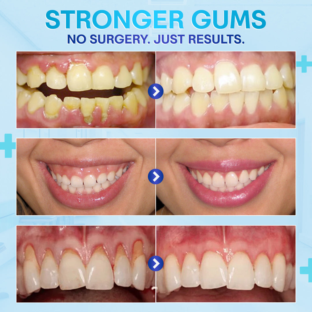 🔥Last Day 75% OFF--🦷 Negusy™ Gum Therapy Agent