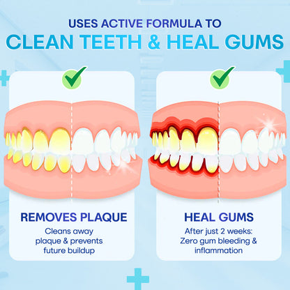 🔥Last Day 75% OFF--🦷 Negusy™ Gum Therapy Agent