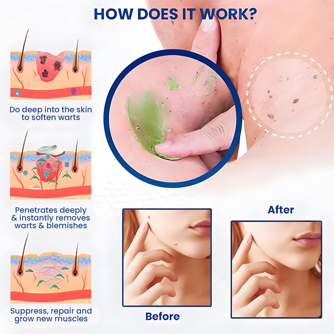 ✨2025 New Arrival🎁Official Store: Seurico™ New NatureVanish Instant Mole & Spot Removal Gel